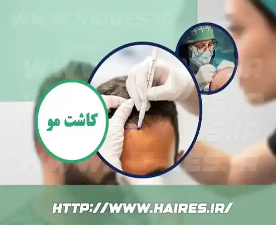 کاشت موی طبیعی